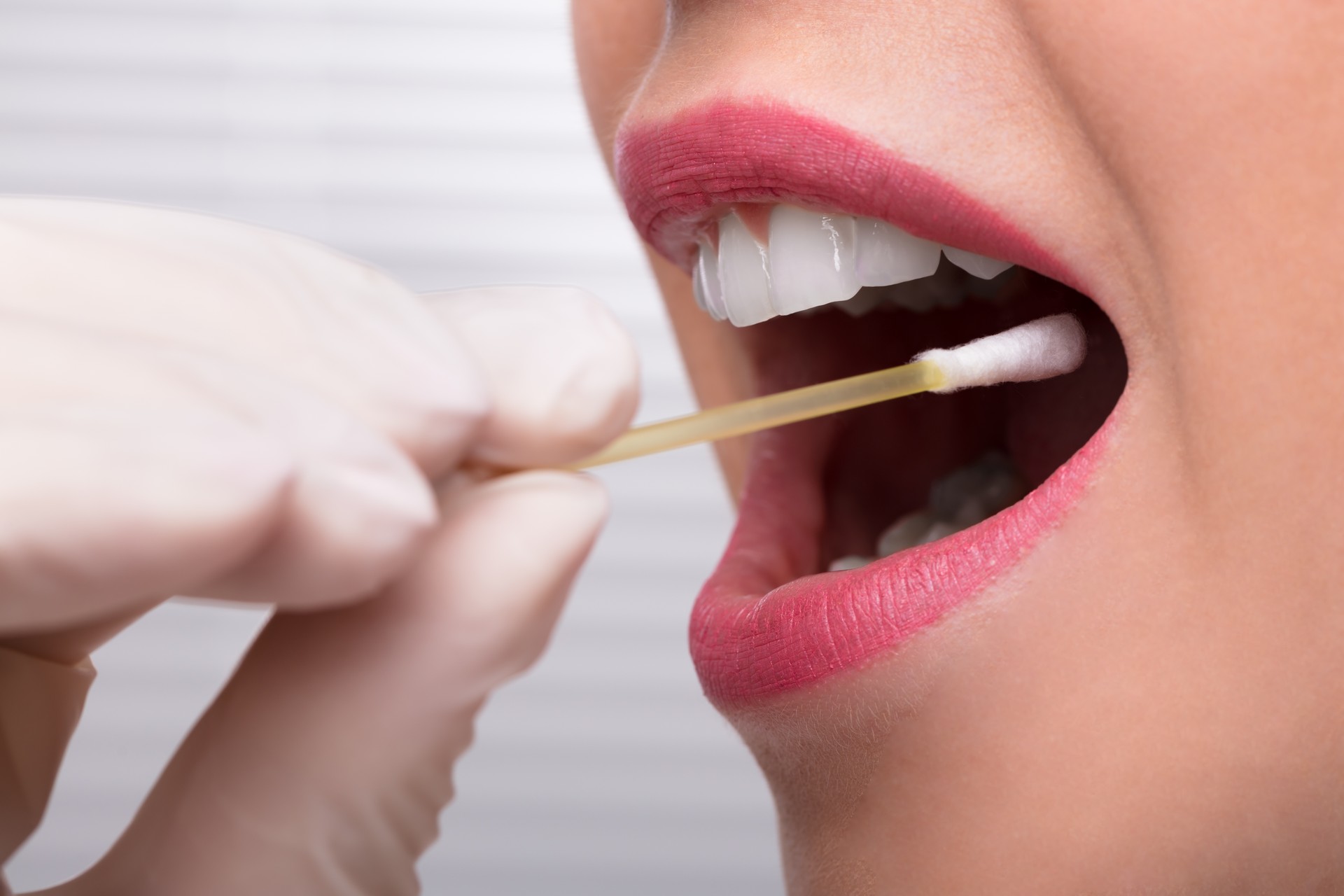 fluoride-treatment-dentist-in-north-hollywood